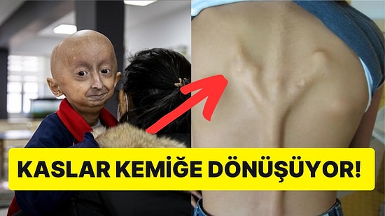 Muhtemelen Daha Önce Hiçbir Yerde Duymadığınız Akıllara Durgunluk Veren Nadir Hastalıklar