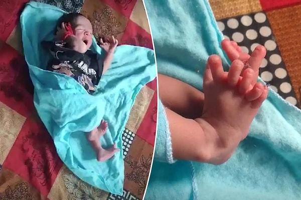 Hindistan'da bir bebek iki elinde 7'şer parmak, iki ayağında 6'şar parmak ile dünyaya geldi.