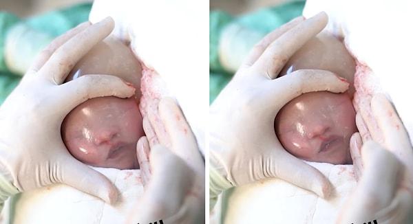 Kadın hastalıkları ve doğum uzmanı  Yrd. Doç. Dr. Erson AKSU, aminyon kesesi ile doğan bir bebek ile, bebeklerin anne karnında nasıl nefes aldığını gösterdi.