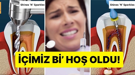 Kanal Tedavisinin Nasıl Yapıldığını Görünce İçiniz Bi' Hoş Olacak!