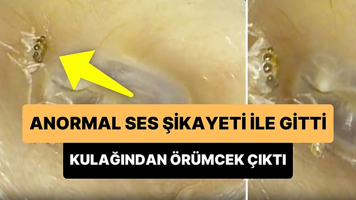 Hoş Geldin Yeni Fobi: Bir Süredir Anormal Sesler Duyduğu İçin Doktora Giden Kadının Kulağından Örümcek Çıktı