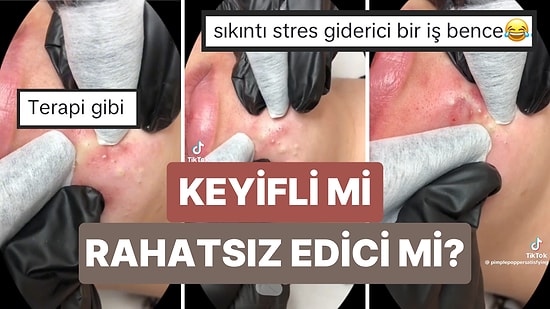 İzlemesi Aşırı Keyifli Şeylerde Bugün! Sivilce Sıkma Görüntülerini Sevenler İçin Terapi Gibi Gelecek Video