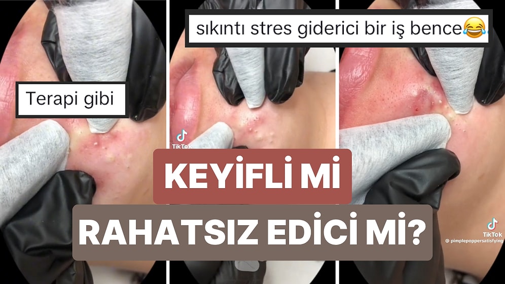 İzlemesi Aşırı Keyifli Şeylerde Bugün! Sivilce Sıkma Görüntülerini Sevenler İçin Terapi Gibi Gelecek Video