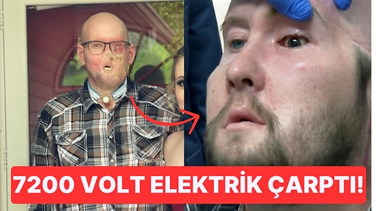 7200 Voltluk Elektrik Çarptıktan Sonra Gözünü Kaybeden Adama İlk Kez Tam Göz Nakli Yapıldı