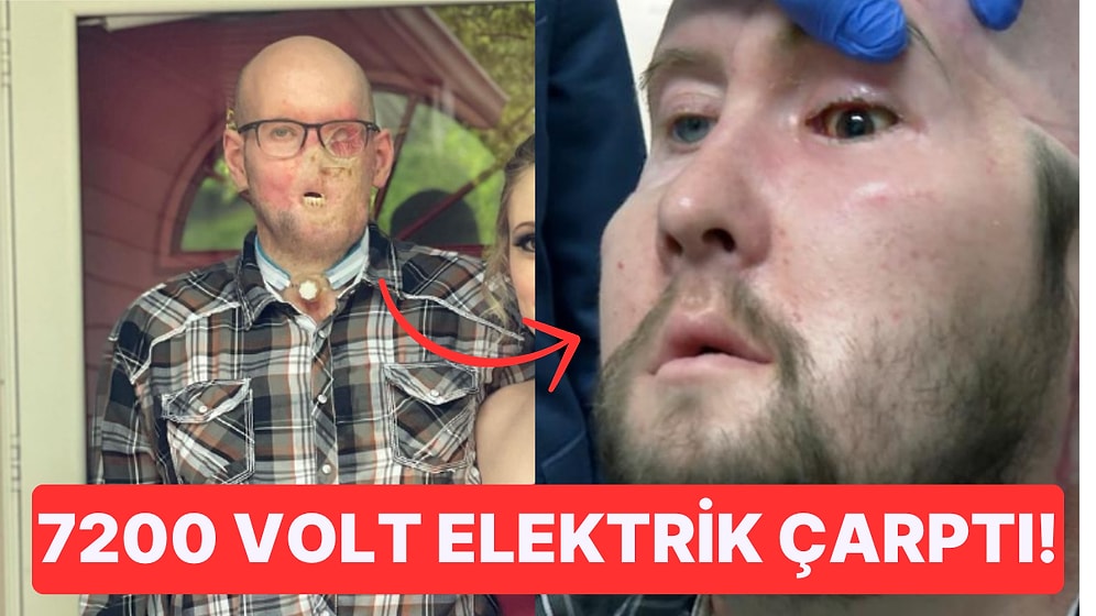 7200 Voltluk Elektrik Çarptıktan Sonra Gözünü Kaybeden Adama İlk Kez Tam Göz Nakli Yapıldı