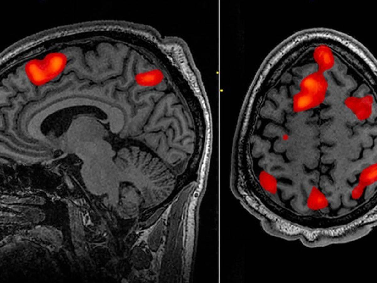Функциональная магнитно-резонансная томография головного мозга. Functional Magnetic Resonance Imaging (FMRI). Зона Брока на мрт.