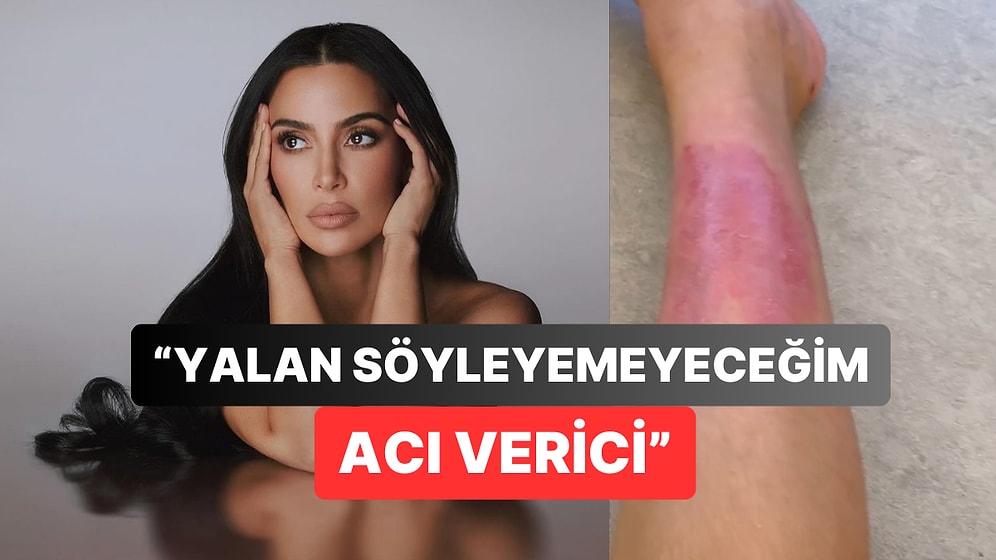 Kim Kardashian Hesabında Bacağında Oluşan Uzun Süreli Yaraları Paylaştı: Takipçileri Şaşkına Döndü