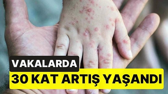 Vakalarda 30 Kat Artış Yaşandı: Uzman İsim Kızamık Salgınına Karşı Uyardı!
