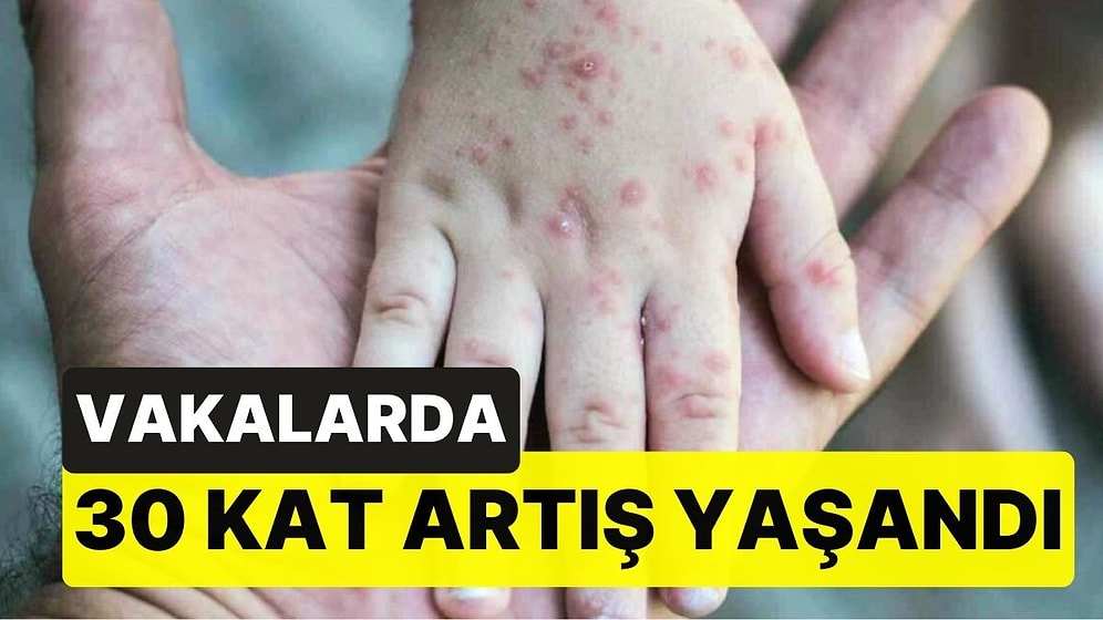 Vakalarda 30 Kat Artış Yaşandı: Uzman İsim Kızamık Salgınına Karşı Uyardı!