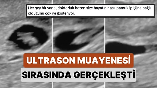 Ultrason Muayenesi Esnasında Canlı Olan Bebeğin O Anda Ana Rahminden Kopup Düştüğü Anlar Kaydedildi