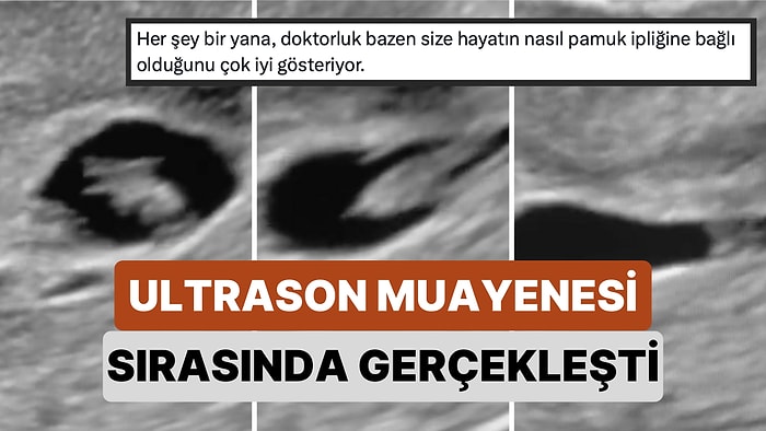 Ultrason Muayenesi Esnasında Canlı Olan Bebeğin O Anda Ana Rahminden Kopup Düştüğü Anlar Kaydedildi