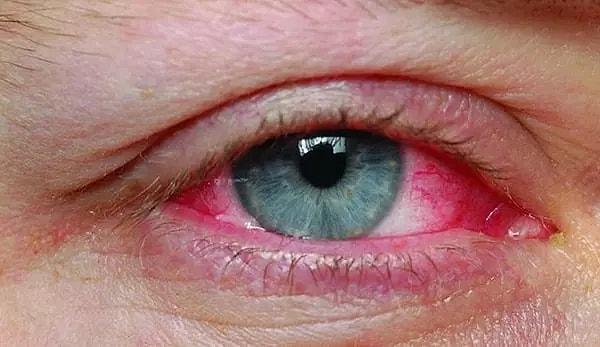 Göz Hastalıkları Uzmanı Op. Dr. Tuncer Güney, kırmızı göz hastalığı ya da göz iltihabı olarak da bilinen konjonktivit vakalarında artış yaşandığını ifade etti.