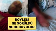 Covid-19 Geçirdikten Sonra Milyonda 2 Görülen Hastalığa Yakalandı: 1 Yıl İçinde Tanınmaz Hale Geldi