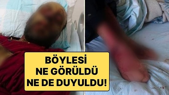 Covid-19 Geçirdikten Sonra Milyonda 2 Görülen Hastalığa Yakalandı: 1 Yıl İçinde Tanınmaz Hale Geldi