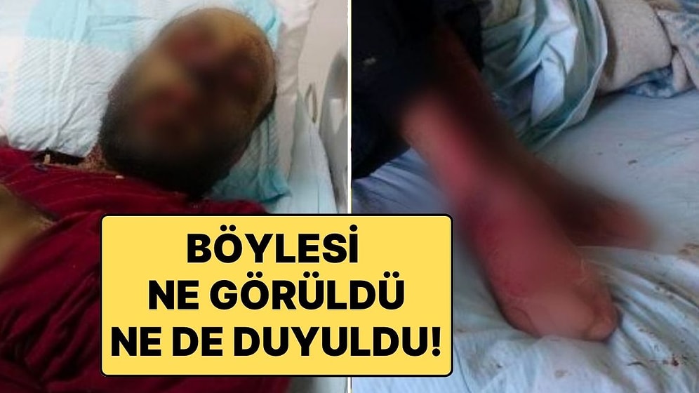 Covid-19 Geçirdikten Sonra Milyonda 2 Görülen Hastalığa Yakalandı: 1 Yıl İçinde Tanınmaz Hale Geldi