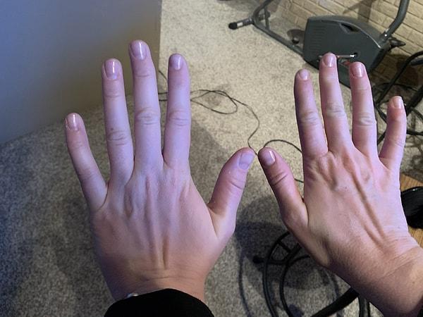 Bu semptomlar, telefonun tek elle kullanımı sırasında serçe parmağın üzerindeki ağırlık nedeniyle meydana geliyor ve parmağın normal hareket sınırlarının dışında zorlanmasına neden oluyor.