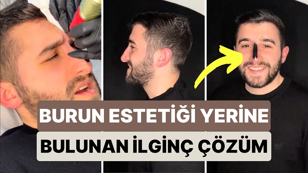 Burun Estetiği Yaptırmak Yerine Bulduğu İlginç Çözümle Hem Beyinleri Hem Kendini Yaktı