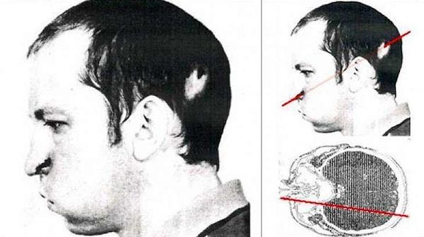 Radyasyon ışını, kemik ve beyin dokusunu yakarak Bugorski'nin yüzünün sol yarısının tamamen felç olmasına sebep oldu.