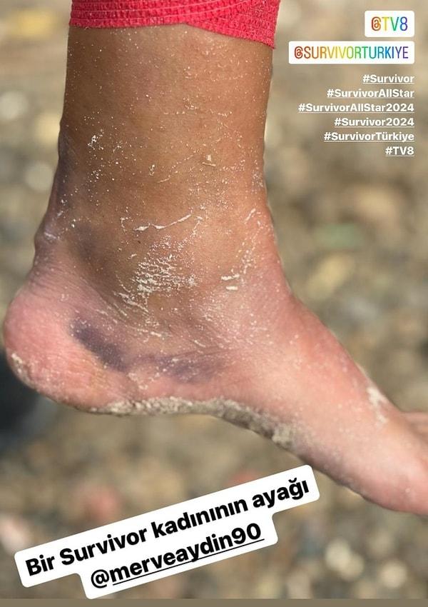 Merve Aydın'ın moraran ayağını "Survivor kadını" diyerek Instagram hesabından paylaşan Acun Ilıcalı dumura uğrattı.