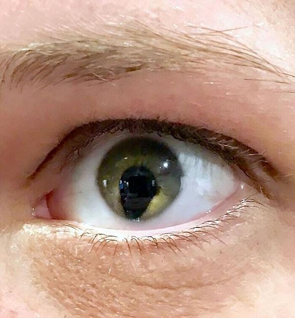 12. Kolobom, doğuştan gelen ve gözün belirli bölgelerinde bazı dokuların olmamasından kaynaklanan bir göz anormalliğidir.