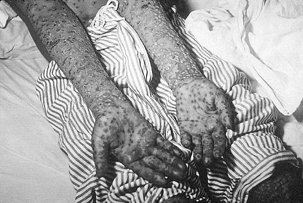 15. Çiçek Hastalığına yakalanan kadının kolları.