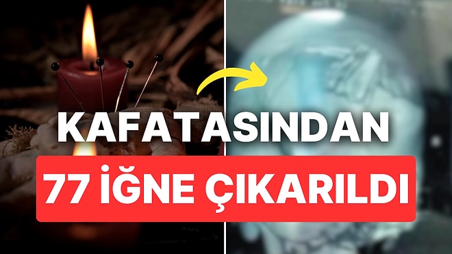 Kafatasından 77 İğne Çıkarıldı: Büyüyü Bozmak Amacıyla 'Tedavi' Yaptırmış