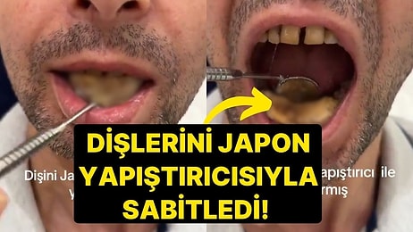 Düşen Dişlerini Sabitlemek İçin Bulduğu Yöntem Görenleri Hayrete Düşürdü! Japon Yapıştırıcısıyla Tutturdu