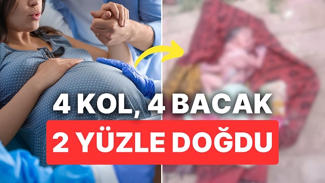 Tıp Dünyası Şokta: Hindistan'da 4 Kollu, 4 Bacaklı ve 2 Yüzlü Bebek Dünyaya Geldi