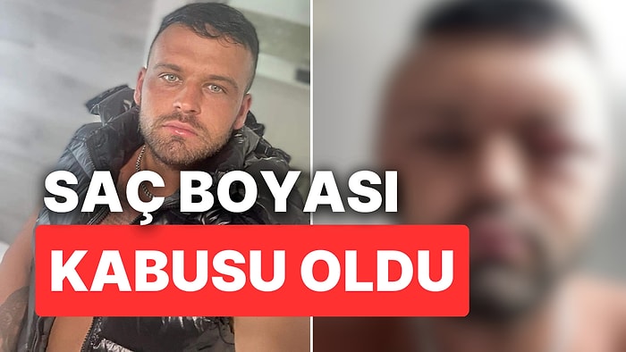 Saç Boyasına Alerjik Reaksiyon Gösteren Adamın Kafası Balon Gibi Şişti