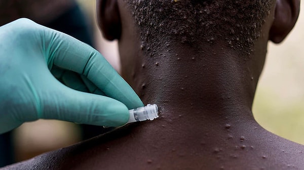 Örgüt, Afrika’da uygulanan acil durumun tüm dünyaya yayılmasına karar verdi.