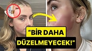 Mikro İğneleme Yaptırdıktan Sonra Cildinde Tüyler Ürpertici Bir Değişimle Karşılaşan Kadın