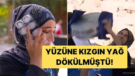 Yüzüne Kızgın Yağ Dökülen MasterChef Beyza ile İlgili Yeni Gelişme!