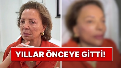 Tüm Yüzüne Yaptırdığı Estetik İşlemlerle 20 Yaş Gençleşen Kadın “Doktor Kim” Dedirtti