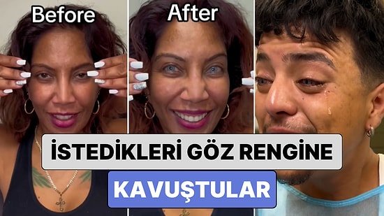 Son Yılların Popüler İşlemi "Göz Rengi Değiştirme" Operasyonu ile İstedikleri Göz Rengine Kavuşanlar