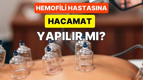 Fitoterapi Uzmanının Hemofili Hastalarına Hacamat Önermesi Sosyal Medyada Ortalığı Karıştırdı