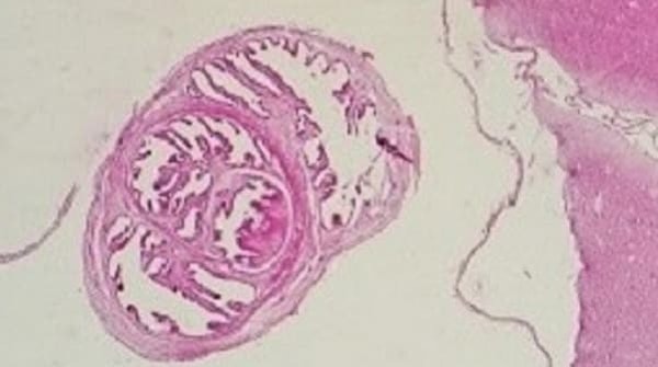 Cysticercosis nedir ve nasıl bulaşır? Bu korkunç durumun adı cysticercosis ve nedeni, Taenia solium adı verilen bir tenya. Hastalık, bu parazitin larvalarıyla enfekte olmuş çiğ ya da az pişmiş domuz etinin tüketilmesiyle ortaya çıkabilir.