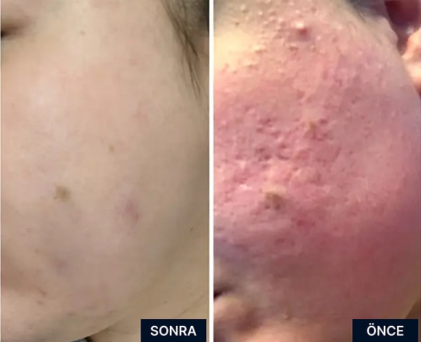 1. CeraVe Akne Sonrası İzler ve Cilt Dokusu İçin Retinol Serumu