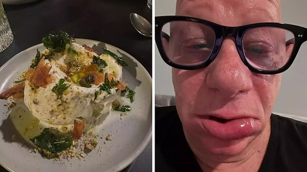 Yaşadığı bu talihsiz anları ve sağlık durumunu Instagram hesabından da paylaşan Ross, “Gerçekten çok lezzetliydi ama dudaklarım patladı. İlk alerjik reaksiyonumdu ve bütün geceyi acil serviste geçirdim” notunu düştü.