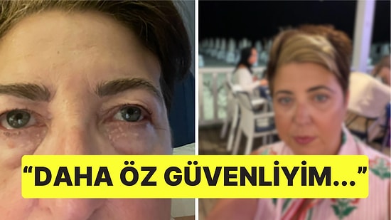 Göz Altı Torbalarından Utandığı İçin Ameliyat Olmaya Karar Veren Kadının Son Hali Şaşırttı