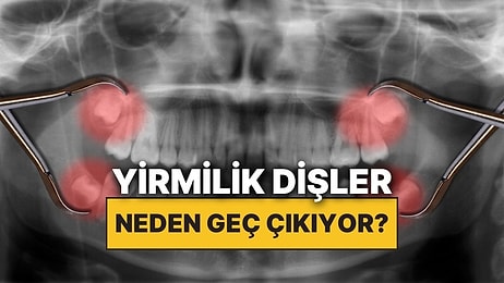 Yirmilik Dişler Neden Çocukken Değil de Yetişkinlikte Çıkıyor?