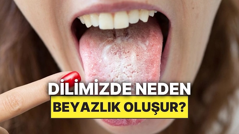 Dilimizin Arka Kısımlarında Oluşan Bu Beyazlığın Sebebi Nedir?
