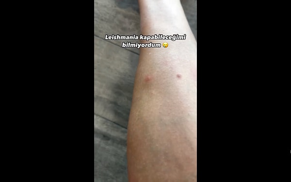 Durumun sivrisinek ısırığı kadar basit olmadığını farkeden kadın, Leishmania kaptığını anladı. Görseli