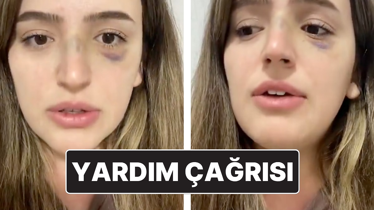 Eşinden Şiddet Gören Kadının Yardım Çağrısı: &quot;Lütfen Sesim Olun&quot;
