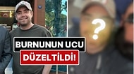 11 Kez Ameliyat Geçiren Murat Dalkılıç'ın Burnunun Ucu Estetik Müdahalelerle Düzeltildi!