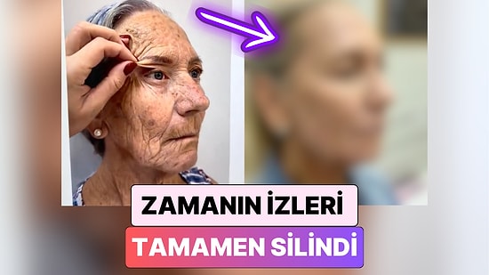 Bir Kadın Geçirdiği Yüz Germe Operasyonu ile 20 Yaş Birden Gençleşti