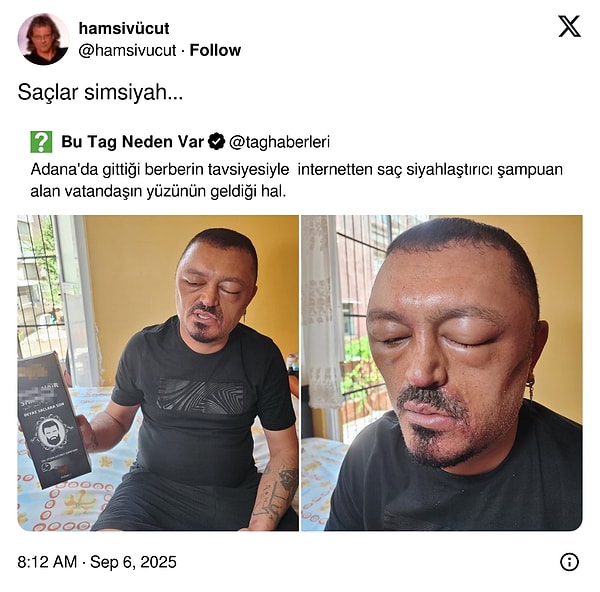 Sonuçta siyahlatmış.