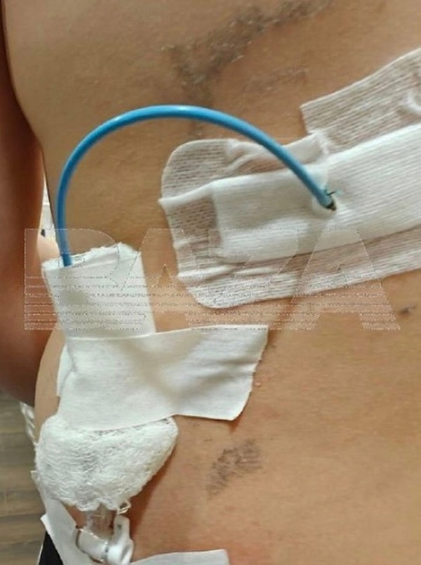 Aslında Maxim’in yaşadığı sorun, idrarın böbrekten mesaneye doğru düzgün akmamasıydı.