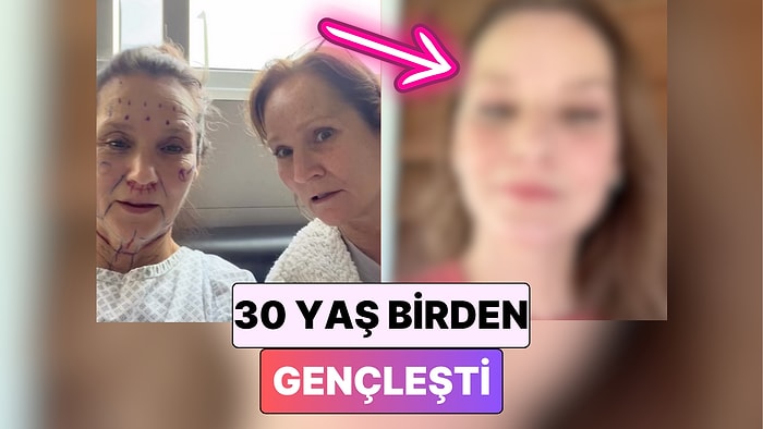 30 Yaş Gençleşti: Aynı Anda Birkaç Estetik Operasyon Geçiren Kadın İnanılmaz Değişimiyle Şaşırttı