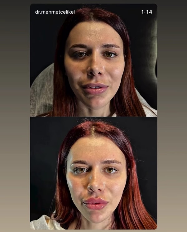 In a post shared by a doctor, Survivor Nefise's cosmetically enhanced look, revealed to be the result of lip fillers, quickly went viral.