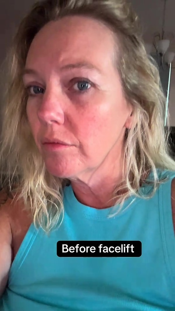 LeeAnn, 45 yaşında Meksika’da yaptırdığı yüz germe operasyonu sonrası neredeyse bambaşka birine dönüştü.